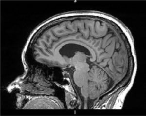 MRI Brain